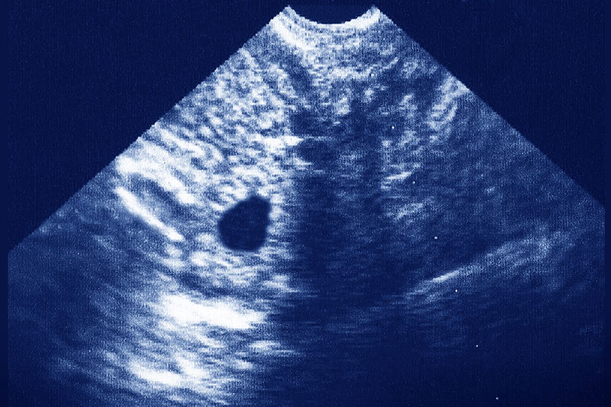 An ectopic pregnancy seen on an abdomino-pelvic scan.