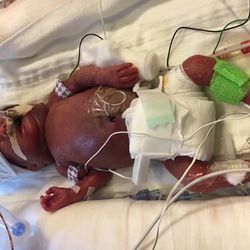 Cayden Baird was born weighing 1 1/2 pounds. His mother, Lizzy Baird, gave birth to him and his twin brother, Levi, 11 days apart.
