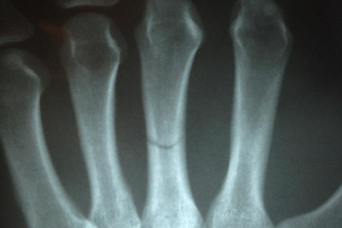 X-ray pic of Luke Rockhold's broken hand, which he sustained in his win over Keith Jardine at last weekends (Jan., 7, 2012) Strikeforce: "Rockhold vs. Jardine" event.
