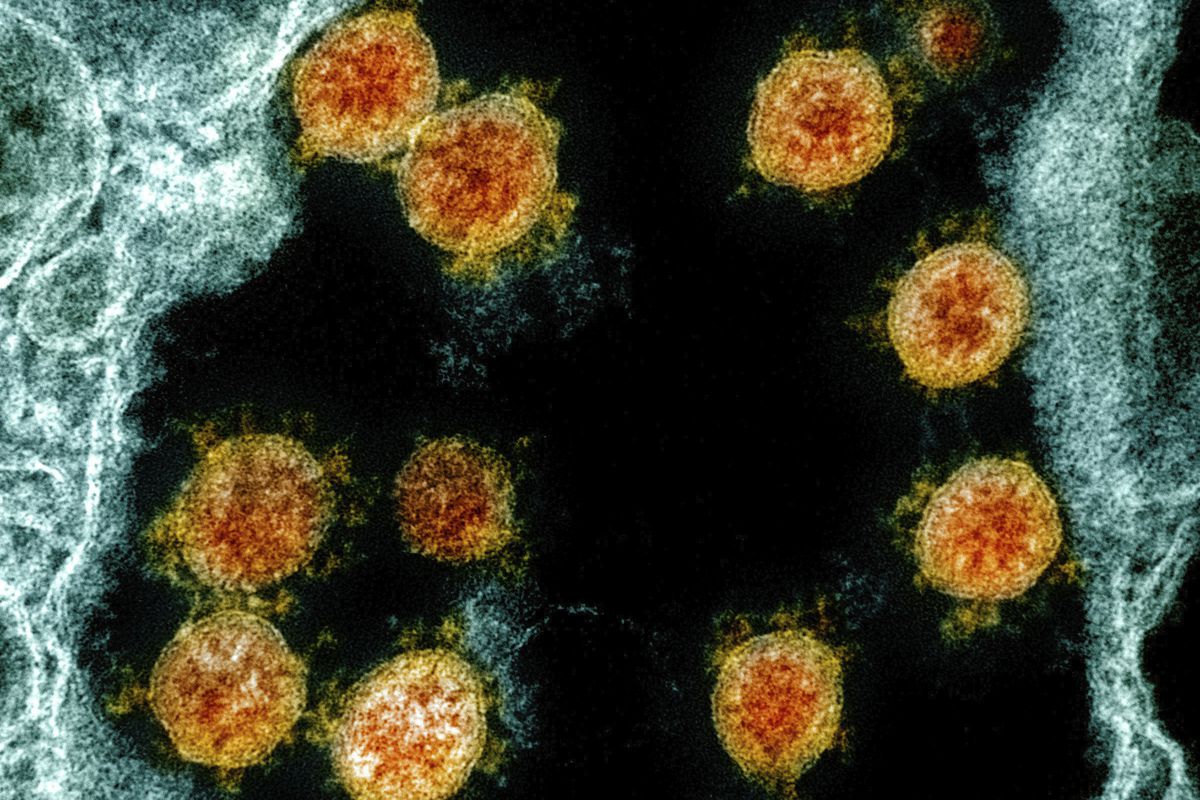 This electron microscope image shows novel coronavirus SARS-CoV-2 virus particles, orange, isolated from a patient.