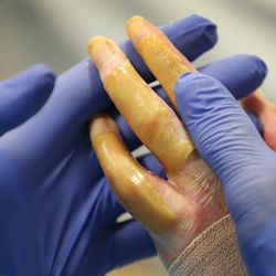 Burn victim Austin Weaver's fingers are during physical therapy at University of Utah Health's Burn Center in Salt Lake City on Friday, July 20, 2018. Weaver's family says his life has essentially been saved by a new burn treatment substance called SkinTE.