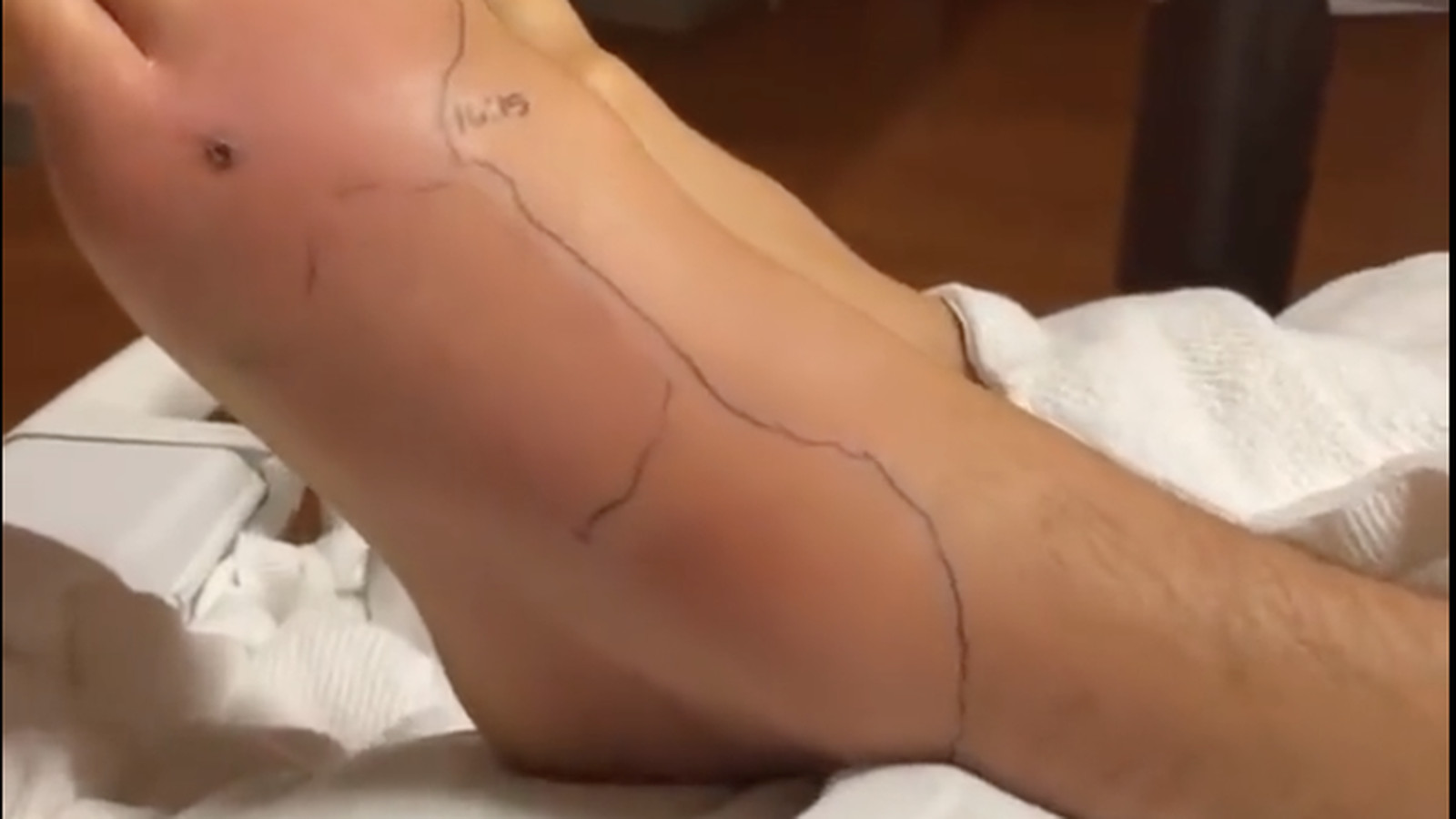 Dustin Poirier enflé et déformé « ne progresse pas » dans une nouvelle vidéo de l’hôpital