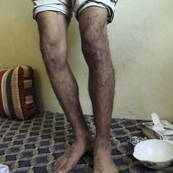 Ali Mansoor Abdel Karim Nasser shows pellet wounds to his legs Saturday, March 19, 2011, at a home in the Shiite Muslim village of Al Kharjiya, Sitra, Bahrain, on the island nation's east coast. 