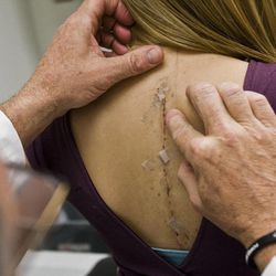One month after having two rods put into her back to straighten her spine, 18 year old Tayler Hansen meets with her physician and orthopaedic surgeon Dr. John Smith at Primary Children's Medical Center in Salt Lake City on  Tuesday, May 3, 2011.  Mike Terry, Deseret News