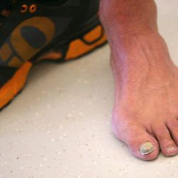 William Calton's severely frostbitten toes were saved with hyperbaric treatment after a climbing accident on Everest at the Ogden Regional Medical Center Wound Care and Hyperbaric Center in Washington Terrace on Thursday, Aug. 30, 2012. 