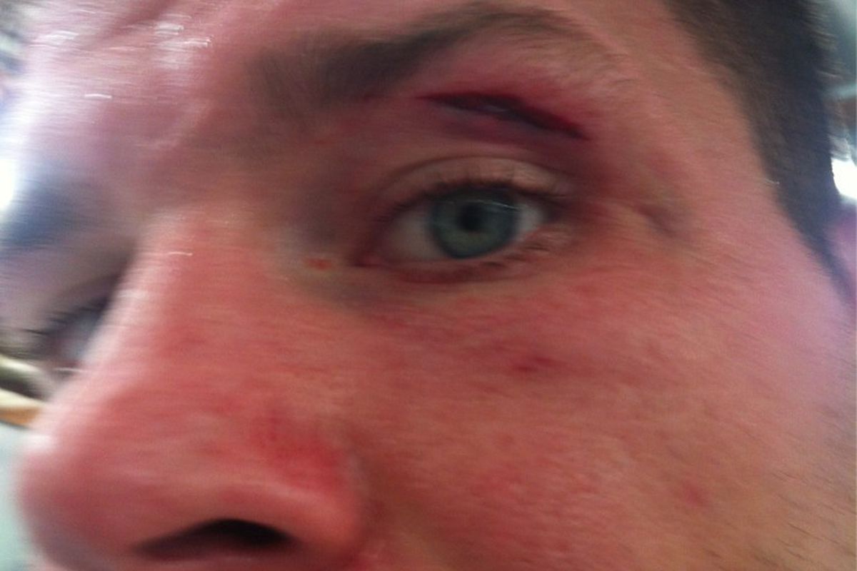 UFC 152's Michael Bisping shows off a cut to his eye that required six stitches to repair.  Photo via Michael Bisping's <a href="http://twitter.com/bisping" target="new">Twitter</a>.