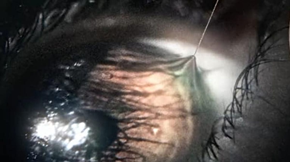 An eye stabbed with a sewing needle it’s gross do not look at it